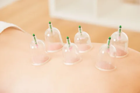 cupping therapy melbourne