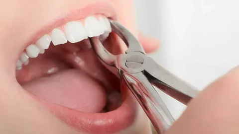  wisdom teeth removal Alexandria

